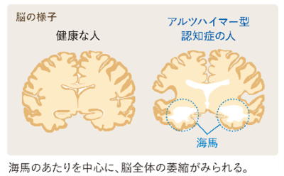 アルツハイマー型認知症の人の脳のイメージ
