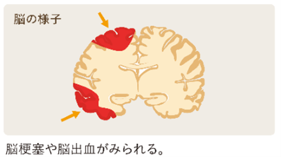 血管性認知症の人の脳のイメージ