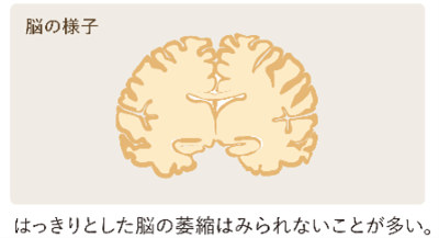 レビー小体型認知症の人の脳のイメージ